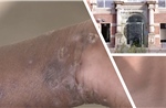 Đức đối mặt rủi ro sức khỏe cộng đồng như thế nào sau khi phát hiện ca mpox biến thể mới đầu tiên