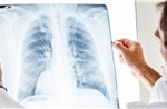 Vaccine ADN đường mũi mở hướng mới trong điều trị lao