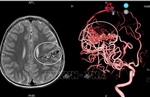Cứu sống bệnh nhi bị dị dạng mạch máu não phức tạp hiếm gặp