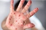 Cảnh giác với nguy cơ bệnh sởi &#39;trở lại toàn cầu&#39;