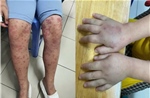 Bác sĩ cảnh báo biến chứng thận nguy hiểm ở trẻ bị ban xuất huyết Schonlein-Henoch