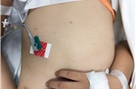 Cảnh báo gia tăng bệnh não mô cầu ở khu vực phía Nam