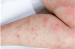 Cảnh báo gia tăng các bệnh về da trong mùa mưa 