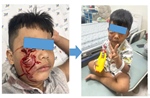 Cấp cứu bé trai 5 tuổi bị chó cắn rách mặt phải khâu 20 mũi 