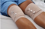 Ứng dụng keo PRF, bước tiến mới trong điều trị bệnh thoái hoá khớp gối