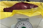 Phẫu thuật thành công khối u xơ tử cung nặng 4,5kg cho nữ bệnh nhân 46 tuổi