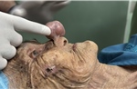 Ca mổ đặc biệt ‘vì thương’ giúp cụ bà gần 100 tuổi thoát khối u che lấp mũi, miệng