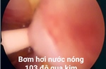 Ứng dụng kỹ thuật 'bốc hơi nước' điều trị phì đại tuyến tiền liệt