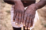 Nam Phi ghi nhận thêm trường hợp mắc bệnh đậu mùa khỉ