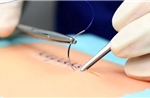 Đột phá phẫu thuật an toàn nhờ nút thắt &#39;lập trình sẵn&#39;
