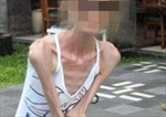 Người phụ nữ Trung Quốc mắc chứng biếng ăn tâm thần sau khi giảm 40kg trong 1 năm