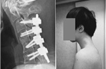 Thanh niên 25 tuổi mắc &#39;hội chứng cúi đầu&#39; hiếm gặp vì nhìn điện thoại quá nhiều