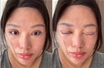 Sáu năm không nhắm được mắt khi ngủ sau khi cắt mí tại cơ sở 'chui'
