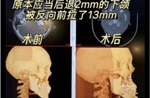 Cô gái Trung Quốc bị biến dạng khuôn mặt sau phẫu thuật chỉnh hàm