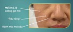 Rãnh mũi má và &#39;râu rồng&#39; ở tuổi trung niên: Phương pháp thẩm mỹ nào an toàn và hiệu quả?