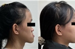 Điều trị móm (khớp cắn ngược) do xương hàm