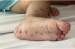 Bệnh nhi 5 tuổi tử vong nghi do mắc tay chân miệng