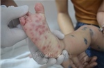 Bệnh tay chân miệng có xu hướng gia tăng