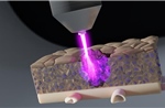 Tia plasma lạnh tiêu diệt tế bào ung thư ẩn sâu