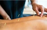 Nghiên cứu Mỹ khẳng định châm cứu hiệu quả với chứng đau lưng mạn tính
