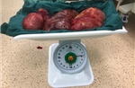 Phẫu thuật cắt khối u xơ nặng gần 5 kg ở bệnh nhân 56 tuổi
