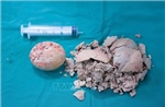 Lấy thành công viên sỏi &#39;khổng lồ&#39; nằm trong cơ thể người bệnh gần 30 năm
