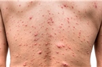 Đảo Sơn Ca cấp cứu một ngư dân bị bệnh thủy đậu giai đoạn toàn phát