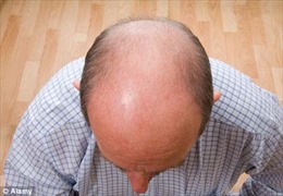 Đàn ông hói đầu dễ bị ung thư tiền liệt tuyến?