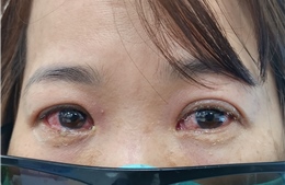 Các biện pháp hiệu quả phòng bệnh đau mắt đỏ lây lan