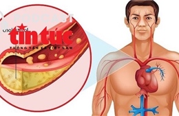 "Bác sĩ ơi&#39; - Kiểm soát Cholesterol máu thế nào là đúng?