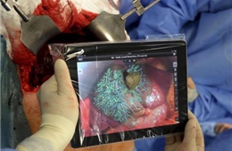 Phẫu thuật gan bằng iPad