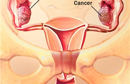Kiểm tra máu phát hiện sớm ung thư buồng trứng 