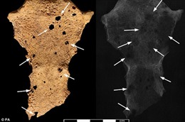 Phát hiện dấu vết ung thư trên bộ hài cốt 3.200 năm tuổi 