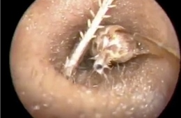 Hãi hùng dế dài 7 cm làm tổ trong tai người