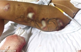 Á hậu vòng ba Brazil suýt bị cưa chân vì phẫu thuật thẩm mỹ