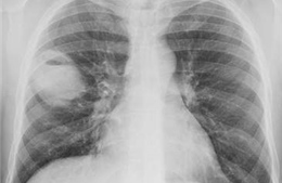 Cứu sống bệnh nhân bị đâm thủng phổi 