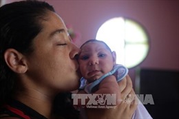 Brazil phát hiện virus Zika trong não của trẻ bị bệnh đầu nhỏ