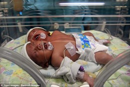 Kỳ lạ trẻ sơ sinh hai đầu ở Indonesia
