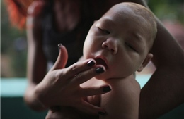 Thái Lan xác nhận 2 trẻ sơ sinh đầu nhỏ vì Zika 