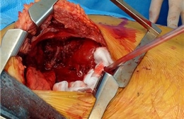Phẫu thuật cắt khối u quái khổng lồ gần 7 kg