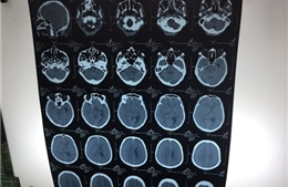 Bệnh viện tuyến quận phẫu thuật thành công chấn thương sọ não 