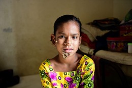 Mắc bệnh lạ, bé gái người Bangladesh &#39;nẩy chồi cây&#39; trên mặt