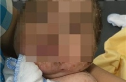 Tắm lá thuốc trị thủy đậu, bé trai 4 tháng tuổi bị nhiễm độc toàn thân