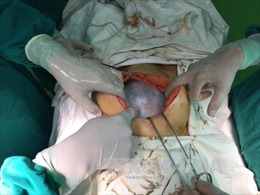 Lấy u quái buồng trứng nặng gần 4 kg khỏi bụng cụ bà 73 tuổi