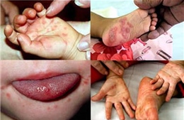 Chăm sóc thế nào với trẻ bị bệnh tay chân miệng?