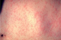 Cách phân biệt bệnh sởi và sốt phát ban