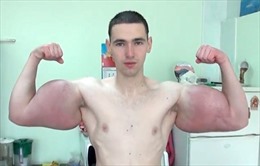 Thanh niên Nga tiêm chất kích thích để có bắp tay ngoại cỡ