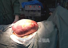 Phẫu thuật loại bỏ thành công khối u buồng trứng nặng 5 kg 