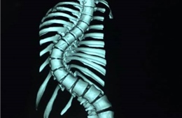 Phẫu thuật thành công cho bé gái có xương sống cong vẹo hình rắn 