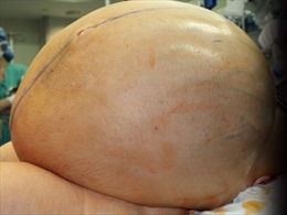 Cắt bỏ khối u nặng 60kg trong buồng trứng bệnh nhân Mỹ